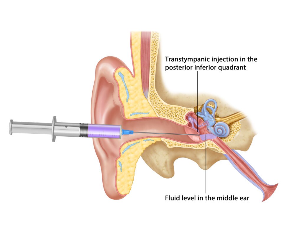 Terlimak Injection Kulak İçi Enjeksiyon (İntratimpanik Enjeksiyon) - Prof. Dr. Mehmet ...