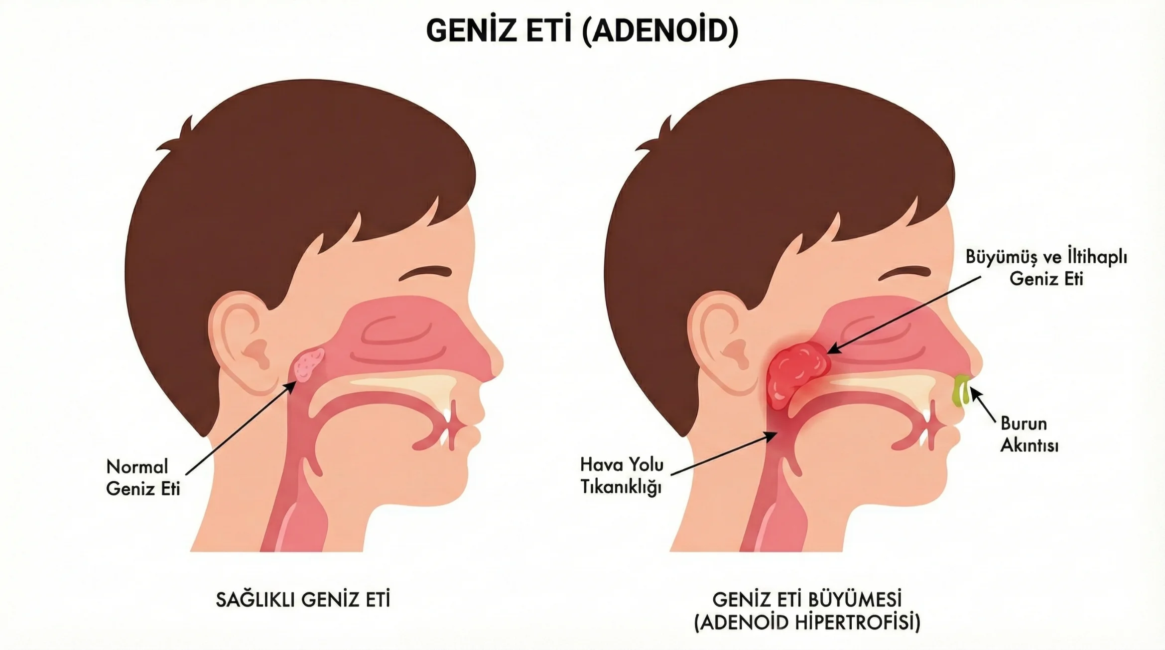 Geniz Eti Ameliyatı